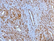 IHC staining of FFPE human pancreatic ductal adenocarcinoma tissue with YY1 antibody. HIER: boil tissue sections in pH8 EDTA for 20 min and allow to cool before testing.