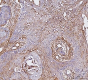 IHC staining of FFPE human esophageal squamous carcinoma tissue with CD51 antibody. HIER: boil tissue sections in pH8 EDTA for 20 min and allow to cool before testing.