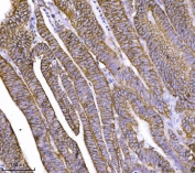 IHC staining of FFPE human colorectal adenocarcinoma tissue with Catenin delta 1 antibody. HIER: boil tissue sections in pH8 EDTA for 20 min and allow to cool before testing.