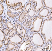 IHC staining of FFPE human thyroid cancer tissue with RING2 antibody. HIER: boil tissue sections in pH8 EDTA for 20 min and allow to cool before testing.