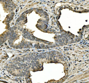 IHC staining of FFPE human prostate cancer tissue with STAT6 antibody, HRP-labeled secondary and DAB substrate. HIER: boil tissue sections in pH8 EDTA for 20 min and allow to cool before testing.