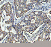 IHC staining of FFPE human colon cancer tissue with TOMM20 antibody. HIER: boil tissue sections in pH8 EDTA for 20 min and allow to cool before testing.