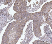 IHC staining of FFPE human adenocarcinoma of lung tissue with Alkyl-DHAP synthase antibody. HIER: boil tissue sections in pH8 EDTA for 20 min and allow to cool before testing.