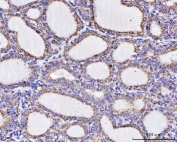 IHC staining of FFPE human thyroid cancer tissue with ATP5A1 antibody. HIER: boil tissue sections in pH8 EDTA for 20 min and allow to cool before testing.