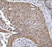 IHC staining of FFPE human esophageal squamous carcinoma tissue with YWHAG antibody. HIER: boil tissue sections in pH8 EDTA for 20 min and allow to cool before testing.