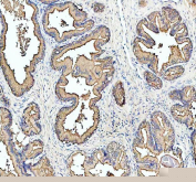 IHC staining of FFPE human prostate cancer tissue with MARS1 antibody, HRP-labeled secondary and DAB substrate. HIER: boil tissue sections in pH8 EDTA for 20 min and allow to cool before testing.