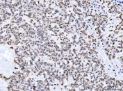 IHC staining of FFPE human breast cancer tissue with STK15 antibody. HIER: boil tissue sections in pH8 EDTA for 20 min and allow to cool before testing.