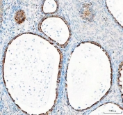 IHC staining of FFPE human ovarian cancer tissue with Glycogen synthase kinase-3 beta antibody. HIER: boil tissue sections in pH8 EDTA for 20 min and allow to cool before testing.