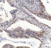 IHC staining of FFPE human endometrial adenocarcinoma tissue with Glycogen synthase kinase-3 beta antibody. HIER: boil tissue sections in pH8 EDTA for 20 min and allow to cool before testing.