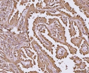 IHC staining of FFPE human lung cancer tissue with YWHAE antibody. HIER: boil tissue sections in pH8 EDTA for 20 min and allow to cool before testing.
