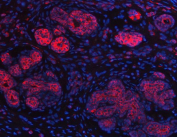 Immunofluorescent staining of FFPE human breast cancer tissue with Inosine-5'-monophosphate dehydrogenase 2 antibody (red) and DAPI nuclear stain (blue). HIER: steam section in pH8 EDTA buffer for 20 min.