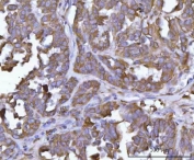 IHC staining of FFPE human ovarian cancer tissue with ERP29 antibody. HIER: boil tissue sections in pH8 EDTA for 20 min and allow to cool before testing.
