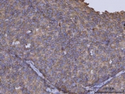IHC staining of FFPE human cervical cancer tissue with ARL1 antibody. HIER: boil tissue sections in pH8 EDTA for 20 min and allow to cool before testing.