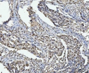 IHC staining of FFPE human laryngeal squamous cell carcinoma tissue with HNRPL antibody. HIER: boil tissue sections in pH8 EDTA for 20 min and allow to cool before testing.