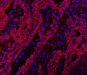 Immunofluorescent staining of FFPE human colorectal adenocarcinoma tissue with CLASP1 antibody (red) and DAPI nuclear stain (blue). HIER: steam section in pH8 EDTA buffer for 20 min.