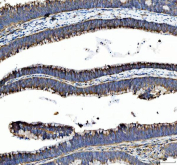 IHC staining of FFPE human colon cancer tissue with MST4 antibody. HIER: boil tissue sections in pH8 EDTA for 20 min and allow to cool before testing.