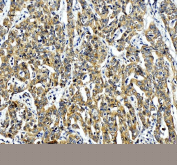 IHC staining of FFPE human liver cancer tissue with ERGIC1 antibody, HRP-labeled secondary and DAB substrate. HIER: boil tissue sections in pH8 EDTA for 20 min and allow to cool before testing.