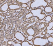 IHC staining of FFPE human thyroid cancer tissue with ANXA10 antibody. HIER: boil tissue sections in pH8 EDTA for 20 min and allow to cool before testing.