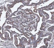 IHC staining of FFPE human cervical cancer tissue with VAPA antibody. HIER: boil tissue sections in pH8 EDTA for 20 min and allow to cool before testing.