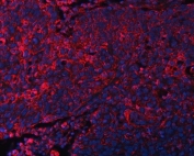 Immunofluorescent staining of FFPE human esophageal squamous cell carcinoma tissue with DOCK1 antibody (red) and DAPI nuclear stain (blue). HIER: boil tissue sections in pH8 EDTA for 20 min and allow to cool before testing.