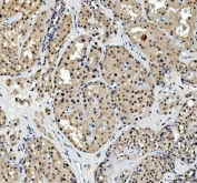 IHC staining of FFPE human thyroid cancer tissue with TBX18 antibody. HIER: boil tissue sections in pH8 EDTA for 20 min and allow to cool before testing.