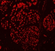 Immunofluorescent staining of FFPE human breast cancer tissue with TBX18 antibody (red). HIER: steam section in pH8 EDTA buffer for 20 min.