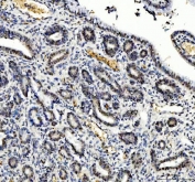 IHC staining of FFPE human moderately differentiated adenocarcinoma of the cervix tissue with TBX18 antibody. HIER: boil tissue sections in pH8 EDTA for 20 min and allow to cool before testing.