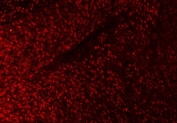 Immunofluorescent staining of FFPE human esophageal squamous carcinoma tissue with SAP18 antibody. HIER: steam section in pH8 EDTA buffer for 20 min.