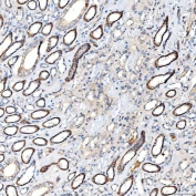 IHC staining of FFPE human renal cancer tissue with Lactadherin antibody. HIER: boil tissue sections in pH8 EDTA for 20 min and allow to cool before testing.