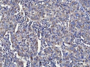 IHC staining of FFPE human cervical cancer tissue with Toll-interacting protein antibody. HIER: boil tissue sections in pH8 EDTA for 20 min and allow to cool before testing.