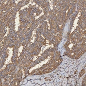 IHC staining of FFPE human thyroid cancer tissue with SEC31A antibody. HIER: boil tissue sections in pH8 EDTA for 20 min and allow to cool before testing.