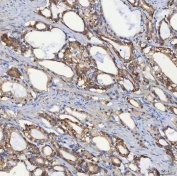 IHC staining of FFPE human prostate adenocarcinoma cancer tissue with SEC31A antibody. HIER: boil tissue sections in pH8 EDTA for 20 min and allow to cool before testing.