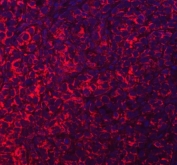 Immunofluorescent staining of FFPE human breast cancer tissue with Acyl-CoA dehydrogenase family member 9 antibody (red) and DAPI nuclear stain (blue). HIER: steam section in pH8 EDTA buffer for 20 min.
