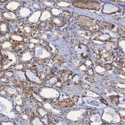 IHC staining of FFPE human prostate adenocarcinoma tissue with Selenium Binding Protein antibody. HIER: boil tissue sections in pH8 EDTA for 20 min and allow to cool before testing.