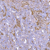 IHC staining of FFPE human ovarian serous cancer tissue with Semaphorin-4F antibody. HIER: boil tissue sections in pH8 EDTA for 20 min and allow to cool before testing.
