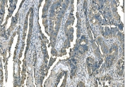 IHC staining of FFPE human rectum adenocarcinoma cancer tissue with GOT1 antibody. HIER: boil tissue sections in pH8 EDTA for 20 min and allow to cool before testing.