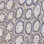 IHC staining of FFPE human colon adenocarcinoma tissue with SLC25A10 antibody. HIER: boil tissue sections in pH8 EDTA for 20 min and allow to cool before testing.