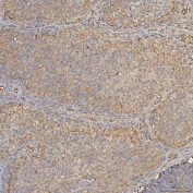 IHC staining of FFPE human endometrioid adenocarcinoma tissue with SLC25A24 antibody. HIER: boil tissue sections in pH8 EDTA for 20 min and allow to cool before testing.