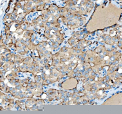 IHC staining of FFPE human thyroid papillary carcinoma tissue with SIAE antibody. HIER: boil tissue sections in pH8 EDTA for 20 min and allow to cool before testing.