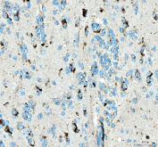 IHC staining of FFPE human glioblastoma tissue with SIAE antibody. HIER: boil tissue sections in pH8 EDTA for 20 min and allow to cool before testing.