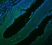 Immunofluorescent staining of FFPE human colon cancer tissue with Citrin antibody (green) and DAPI nuclear stain (blue). HIER: steam section in pH8 EDTA buffer for 20 min.