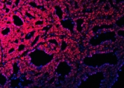 Immunofluorescent staining of FFPE human ovarian cancer with OTT3 antibody (red) and DAPI nuclear stain (blue). HIER: steam section in pH6 citrate buffer for 20 min.
