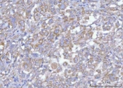 IHC staining of FFPE human lung adenocarcinoma tissue with Hamartin antibody. HIER: boil tissue sections in pH8 EDTA for 20 min and allow to cool before testing.