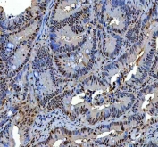 IHC staining of FFPE human rectum adenocarcinoma tissue with P15RS antibody. HIER: boil tissue sections in pH8 EDTA for 20 min and allow to cool before testing.