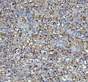 IHC staining of FFPE human glioblastoma tissue with P15RS antibody. HIER: boil tissue sections in pH8 EDTA for 20 min and allow to cool before testing.