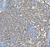 IHC staining of FFPE human lung cancer tissue with P15RS antibody. HIER: boil tissue sections in pH8 EDTA for 20 min and allow to cool before testing.
