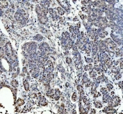 IHC staining of FFPE human ovarian cancer tissue with P15RS antibody. HIER: boil tissue sections in pH8 EDTA for 20 min and allow to cool before testing.