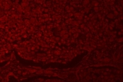 Immunofluorescent staining of FFPE human lung cancer tissue with RNF40 antibody (red). HIER: steam section in pH8 EDTA buffer for 20 min.