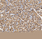 IHC staining of FFPE human pancreatic cancer tissue with Ribophorin II antibody, HRP-secondary and DAB substrate. HIER: boil tissue sections in pH8 EDTA for 20 min and allow to cool before testing.