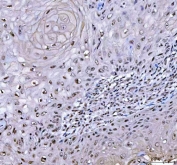 IHC staining of FFPE human skin squamous cell carcinoma tissue with RTCB antibody. HIER: boil tissue sections in pH8 EDTA for 20 min and allow to cool before testing.